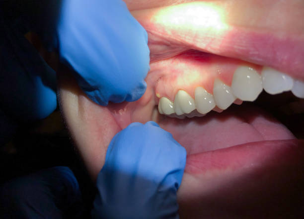 Best Emergency Wisdom Teeth Removal in Snyderville, UT